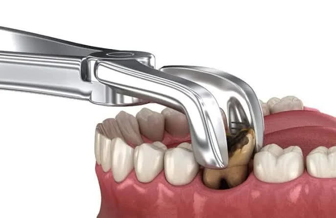 Tooth Extraction: Procedure And Aftercare